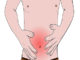 Le syndrome de l'intestin irritable (SII)