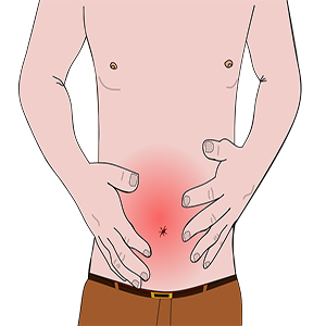 Le syndrome de l'intestin irritable (SII)