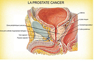 Cancer de la prostate: symptômes, traitement et causes