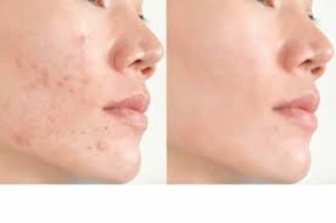 13 remèdes maison puissants pour l'acné